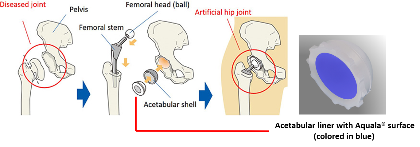 Kyocera_Mechanism of Hip Joint Replacement Technology.png
